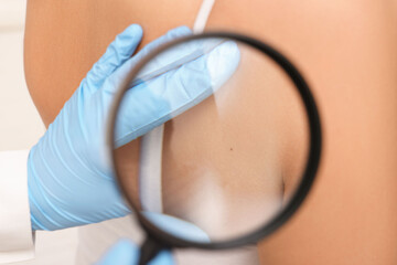 Dermatologist examining patient's birthmark with magnifying glass, closeup