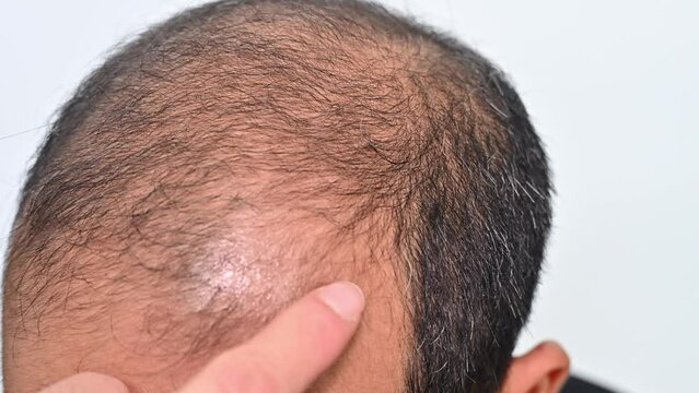 Someone hand touching Asian baldness man scalp for checking hair loss problem.