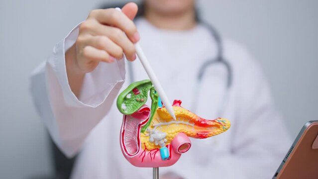 Doctor with human Pancreatitis anatomy model with Pancreas, Gallbladder, Bile Duct, Duodenum, Small intestine. Pancreatic cancer, Acute and Chronic pancreatitis,  Digestive system and Health concept