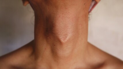 Photo of a man's Adam's apple and neck area protruding against