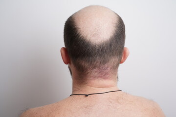 Naklejka premium Bald head close-up. The problem of hair loss in men. Alopecia in men.