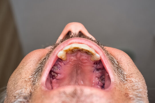 Upper male palate with the gum stitched after the extraction of the molars, with splinting on the incisor teeth.