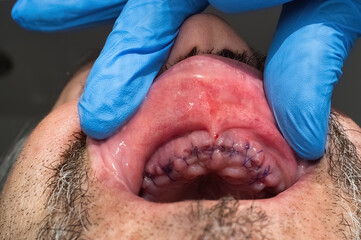 Upper male palate with the gum stitched after the extraction of the incisor teeth. - obrazy, fototapety, plakaty