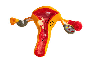 Human uterus model with sicknesses, isolated on blank background.