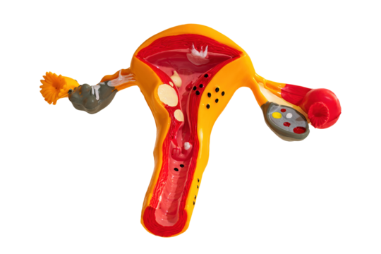 Human uterus model with sicknesses, isolated on blank background.