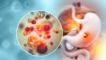 Stomach cancer, symptoms, stages, treatment, 3d illustration