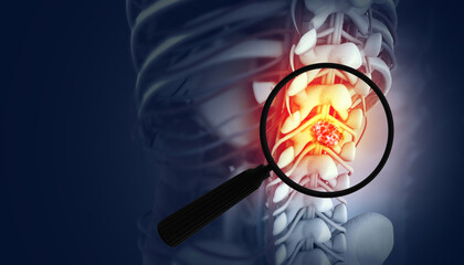 Magnifying glass showing the spine cancer or spinal tumor disease. 3d illustration - obrazy, fototapety, plakaty