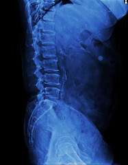 Film x-ray lumbar spine , L-S spine (Lateral view)