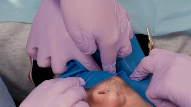 Unveiling the Art of Rubber Dam Placement: Achieving Optimal Isolation for Dental Excellence