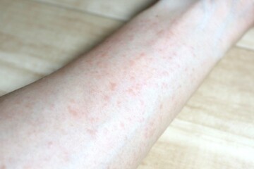 コリン性蕁麻疹を発症した男性の腕