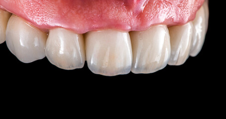 emax crowns on teeth and implants