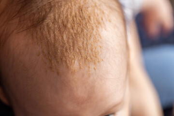 Seborrheic dermatitis on the skin on the head of a 6 month old baby. Yellow scales on the head, close-up - obrazy, fototapety, plakaty