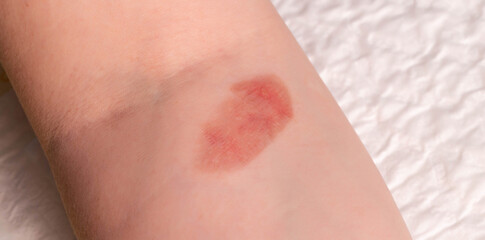 Red spot on the skin, skin damage from a burn on the arm. Close-up