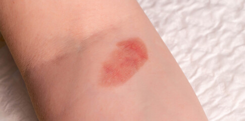 Red spot on the skin, skin damage from a burn on the arm. Close-up