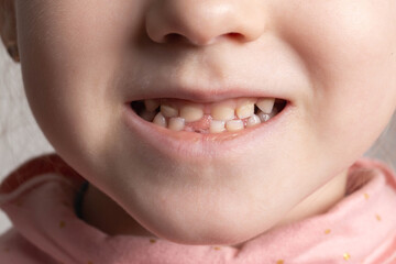 Beautiful smile of a child without one tooth. Change of milk teeth. Extraction of teeth for...