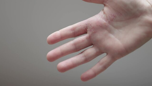 dermatitis, psoriasis eczema and dry skin of palm hands, itchy inflammatory condition. round spots, coin-shaped lesions, small blisters and cracks occur discoid eczema. dermatological illness consept