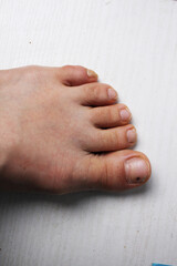 left leg, foot close-up with injured big toe, hematoma, bruising on the nail plate, nail of the big...