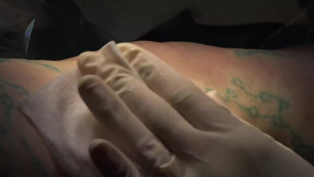 Surgery For Varicose veins performed in the hospital