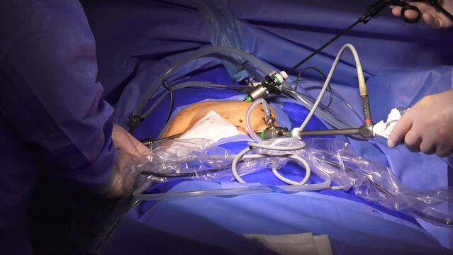 Two surgeons performing a Laparoscopic Surgery in the hospital
