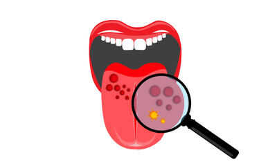 illustration of mouth and tongue examined with a magnifying glass due to infection and bacteria. papillomavirus on tongue or oropharyngeal cancer