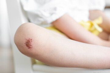 Wound on the girl's knee. The child fell and injured his knee. Scratch on the skin.
