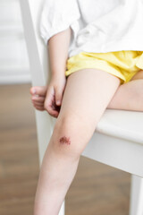 Wound on the girl's knee. The child fell and injured his knee. Scratch on the skin.