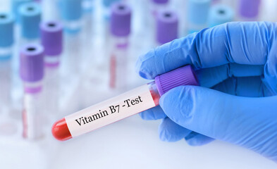 Doctor holding a test blood sample tube with Vitamin B7 test on the background of medical test tubes with analyzes