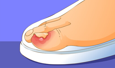 Finger with an ingrown toenail. Uncomfortable shoes. Healthcare illustration. Vector illustration.