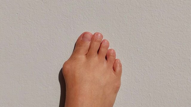 A woman right foot with hallux valgus, Foot Bunions.