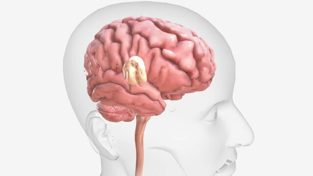 A brain tumor is a growth of cells in the brain or near it