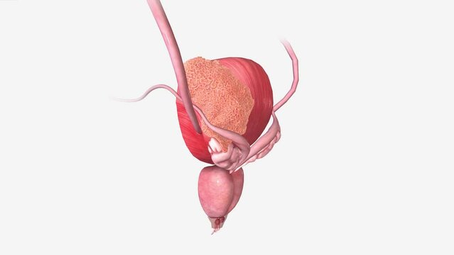 Bladder Cancer Stage III The cancer has spread to 2 or more regional lymph nodes or to the common iliac lymph nodes