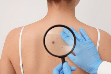 Dermatologist examining patient's birthmark with magnifying glass on beige background, closeup
