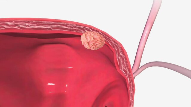 Bladder Cancer Stage II
