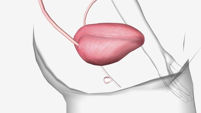 A urethral diverticulum (UD) is a rare condition where an unwanted pocket or sac forms along the urethra,