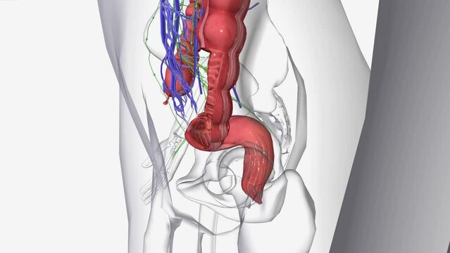 Stage III colon cancers have spread to nearby lymph nodes, but they have not yet spread to other parts of the body