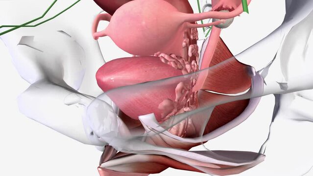Cervical Cancer Stage 4 means the cancer has spread to the bladder or back passage (rectum) or further away