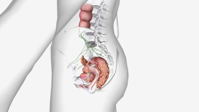 Stage IV is divided into stages IVA and IVB, based on how far the cancer has spread. In stage IVA, cancer has spread to the bladder and/or bowel wal