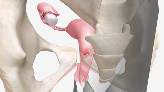 3d Pelvic Pain and Inflammation