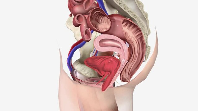 cystocele Grade 1 is the mildest form of the condition, and grades 3 and 4 are the most serious.