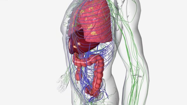 Stage 4 colon cancer is the most serious and advanced stage. It means the cancer has spread outside of the colon to other parts of the body