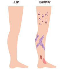 下肢静脈瘤　血管の病気　医療