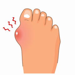 Сhild has stomatitis in mouth. Diseases of oral cavity. Candidiasis in girl