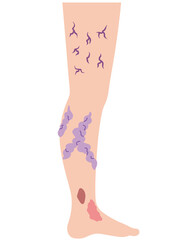 下肢静脈瘤　血管の病気　医療