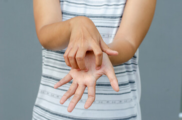 young asian woman scratching itch with hand on palm area, health care concept, dermatosis