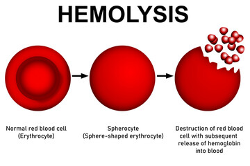 Scientific diagram and process of hemolysis