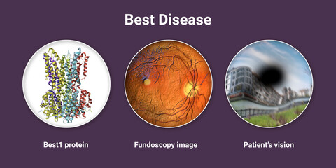 Best disease. Best vitelliform macular dystrophy, illustration