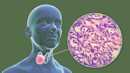 A 3D scientific illustration showcasing a female body with transparent skin, revealing a tumor in her thyroid gland, along with a micrograph image of thyroid cancer.