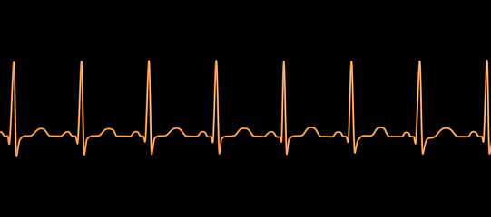 Electrocardiogram ECG displaying sinus tachycardia, 3D illustration