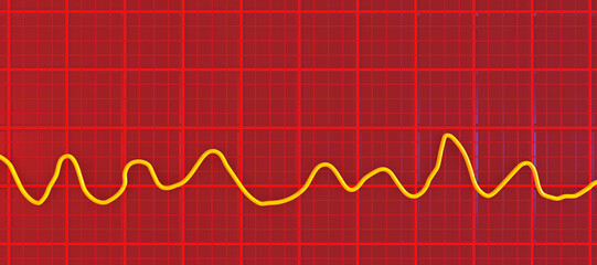 Naklejka premium Electrocardiogram ECG displaying ventricular fibrillation rhythm, 3D illustration
