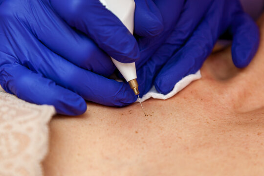 Removal of papillomas on the body